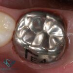 روکش دندان های شیری چیست و استفاده از آن چه ضرورتی دارد؟