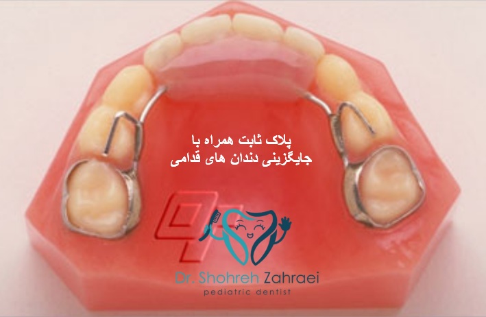 پلاک ثابت همراه با جایگزینی دندان های قدامی